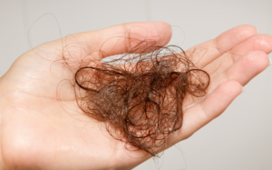 Tóc mỏng và rụng tóc: Do mất cân bằng hormone!