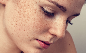 Cẩm nang chăm sóc da: 3 loại tăng sắc tố da thường gặp