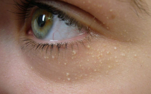 Cách hỗ trợ điều trị và làm mờ mụn thịt trên da ngay tại nhà