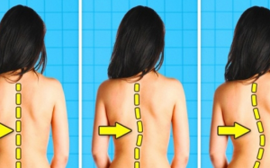 Cong vẹo cột sống phải điều trị thế nào?