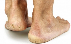 8 cách đơn giản 'trị' nứt gót chân vào mùa Đông