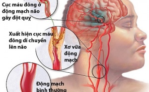 Chiết xuất ginkgo biloba có thể giúp cải thiện trí nhớ cho bệnh nhân đột quỵ