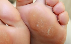 Làm giảm tình trạng chai chân ở thai phụ bằng cách nào?