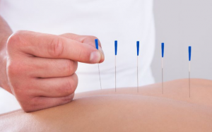 Châm cứu có giúp giảm đau lưng? 