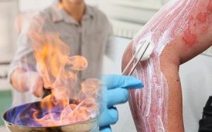 Những bước cần nhớ khi xử trí vết bỏng