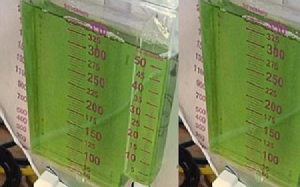 Nước tiểu màu xanh nhạt có bình thường?