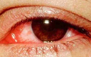 Tập thể dục cường độ vừa và mạnh làm giảm đáng kể bệnh tăng nhãn áp?