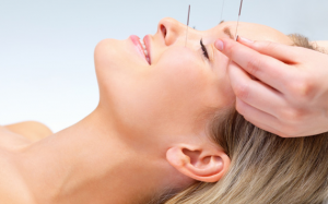 Châm cứu có giúp giảm đau đầu và đau nửa đầu? 