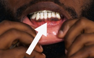 Video: Vì sao nướu răng của bạn bị thâm đen, tối màu?