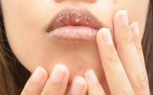 Môi khô, nứt nẻ và bong tróc vì nguyên nhân nào?