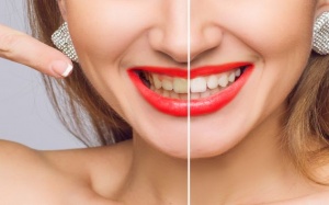 Thói quen chăm sóc răng miệng có thể khiến răng ố vàng