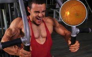 Tập thể dục cường độ cao dễ khiến nam giới bị thoái hóa điểm vàng