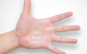 Ra mồ hôi tay ở trẻ em: Nguyên nhân vì đâu?