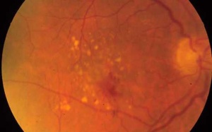 Bổ sung kẽm giúp ngăn ngừa bệnh thoái hóa điểm vàng tiến triển?