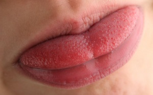 Nguyên nhân nào gây viêm, nhiệt lưỡi?