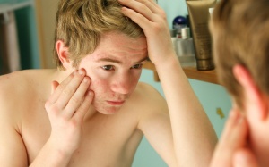 Cách trị hết mụn mà vẫn an toàn cho da?