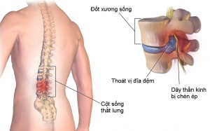 Dùng TPCN Cốt Thoái Vương có giúp giảm đau thoát vị đĩa đệm khi thay đổi thời tiết?