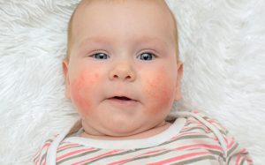 12 triệu chứng dị ứng trứng ở trẻ sơ sinh và trẻ nhỏ