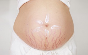 Thời gian mang thai nên bôi loại kem nào để hạn chế sự rạn da?