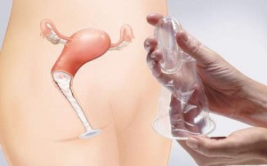 Các biện pháp tránh thai dành cho nữ