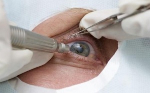 Đái tháo đường làm tăng gấp đôi nguy cơ đục thủy tinh thể 