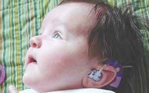 Ốc cấy tai cho người bị điếc sâu