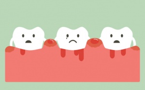 9 dấu hiệu 'chỉ điểm' bạn đang bị viêm lợi hay nha chu