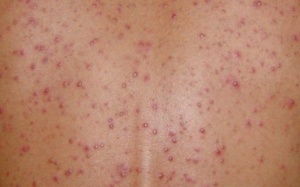 Bị mụn cá ở lưng, chữa trị thế nào?