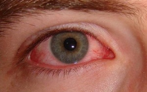 Nguyên nhân nào gây viêm kết mạc mùa Xuân?