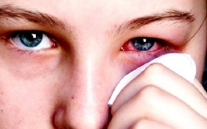 Bệnh viêm kết mạc mùa Xuân có lây không?