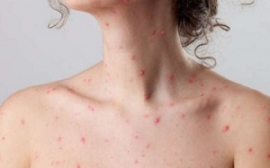 Biến chứng thủy đậu ở người lớn: Không cẩn thận dễ tử vong!