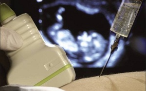 Xét nghiệm chọc dò ối khi mang thai khi nào cần thực hiện?