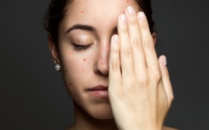 Bí quyết điều trị thủy đậu không để lại sẹo