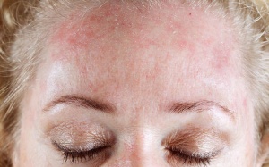 Cách đối phó với 4 vấn đề thường gặp ở da