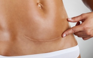 Có cách nào làm mờ sẹo sau sinh mổ?