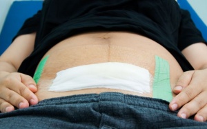 7 điều không nên làm sau sinh mổ