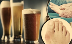 Uống bia có làm tăng nguy cơ mắc bệnh gout?