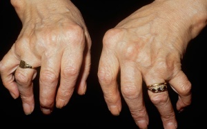 Làm sao để phát hiện sớm viêm khớp dạng thấp?