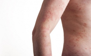 5 thực phẩm cần tránh khi bị eczema