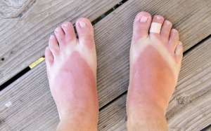 Làm sao để hồi phục làn da bị cháy nắng?