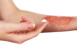 5 cách giúp trị sẹo bỏng hiệu quả