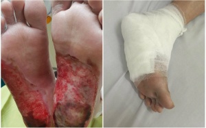 Bệnh nhân đái tháo đường bỏng chân vì dùng đèn sưởi đá muối Himalaya 