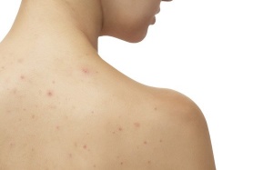Các biện pháp tự nhiên trị mụn trứng cá ở lưng và vai hiệu quả 