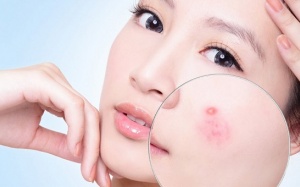 Muốn trị mụn trứng cá: Hãy cân bằng hormone!