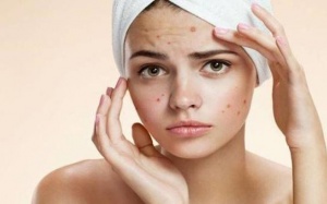 Trị mụn nhọt và mụn trứng cá đơn giản ngay tại nhà