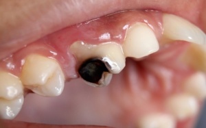 Nguyên nhân nào gây sâu răng?