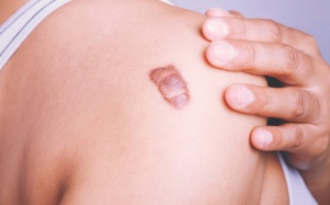 Infographic: Sẹo lồi là gì và những ai dễ bị sẹo lồi?