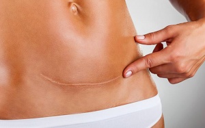 Bất ngờ với hiệu quả làm mờ sẹo lồi của hành, tỏi và mật ong