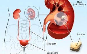 Làm thế nào để ngăn ngừa sỏi thận vào mùa Hè?