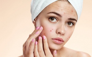 7 loại mụn trứng cá thường gặp và cách xử trí mụn 